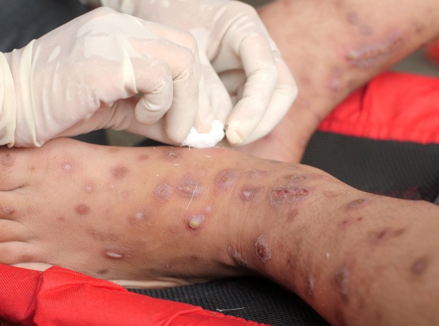 Balcony likely to blame for hospitals fungal outbr