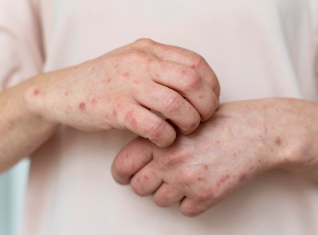 Contact tracing ongoing after rare mpox strain det