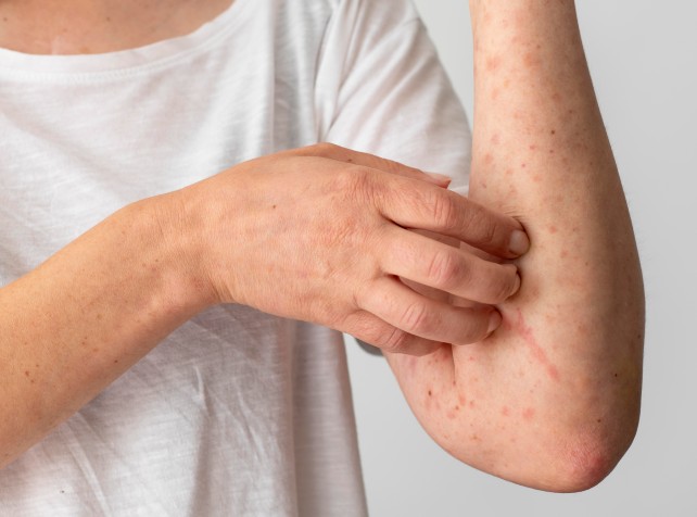 Measles spreading locally as cases spark exposure 