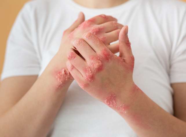 Mpox no longer an international health emergency: 