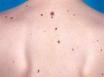 Thin melanomas still dangerous: Qld study